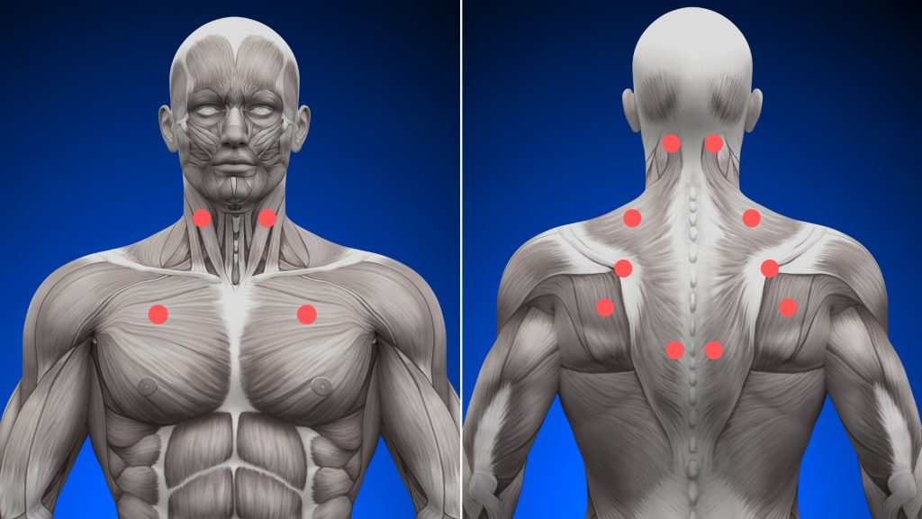 What Are Muscle Knots How To Cure Myofascial Trigger Points Physiosunit
