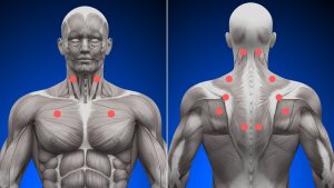 What are Muscle Knots? How to Cure Myofascial Trigger Points