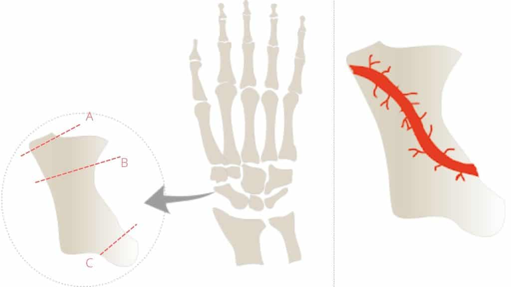 scaphoid fracture picture