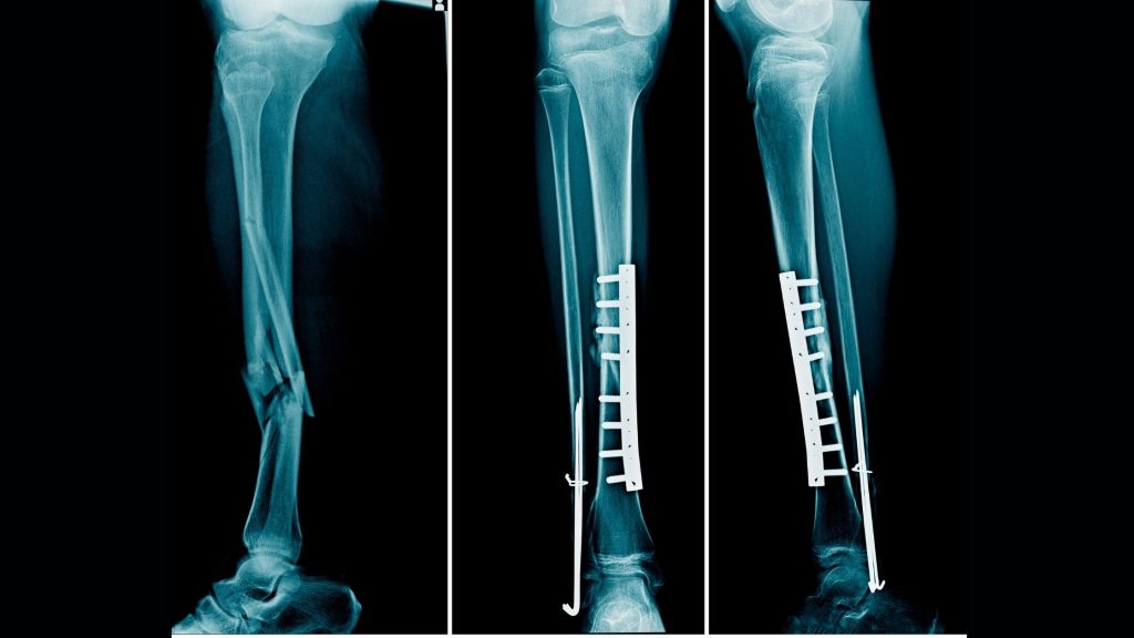 How Much is a Tibial Plateau Fracture Worth? Car & Truck Accidents, Etc.