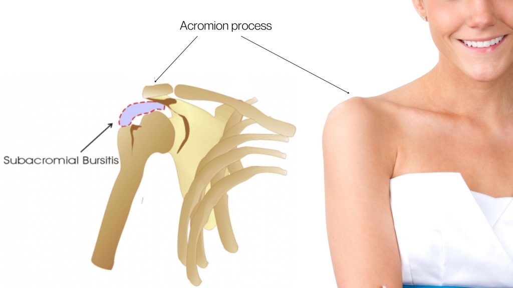 shoulder bursitis anatomy
