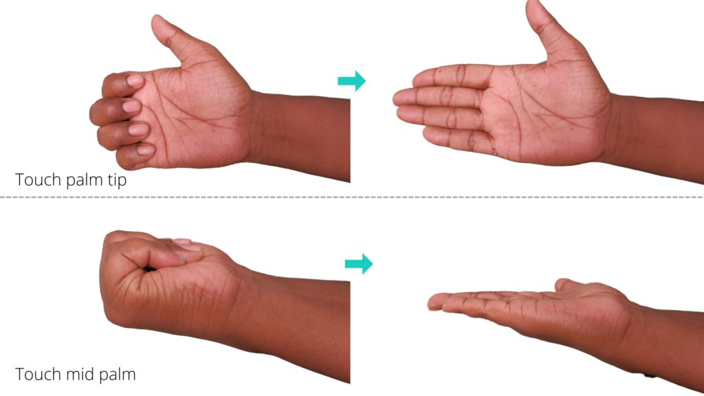 dupuytren's contracture exercises