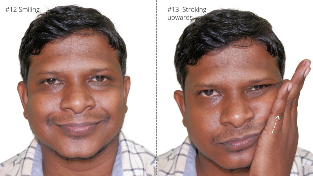 bells palsy physiotherapy treatment