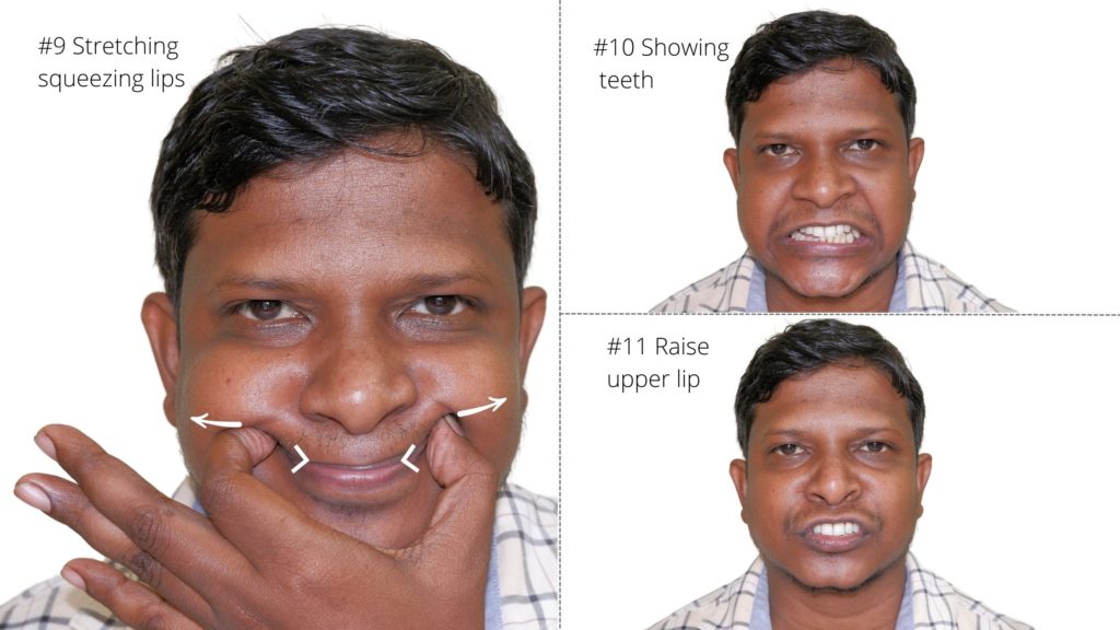 facial exercises for bells palsy