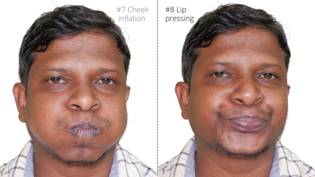 lip exercise for bells facial palsy exercises