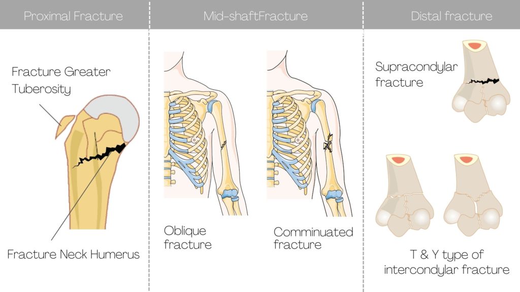 types of humerus fracture, proximal fracture, mid-shaft fracture, distal fracture