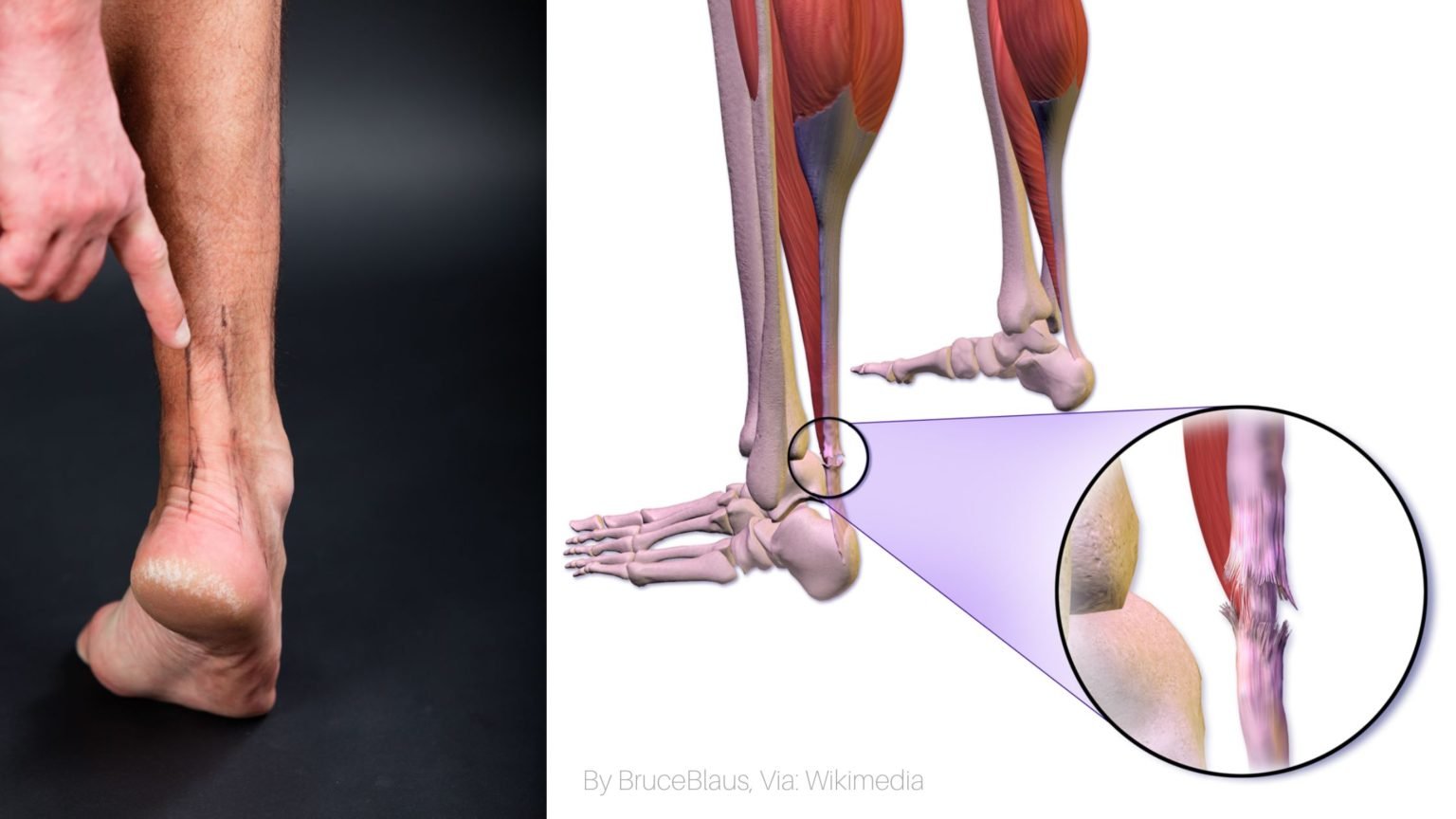 Tenson Rupture Achilles Rupture Tendon: Everything you should know - PHYSIOSUNIT