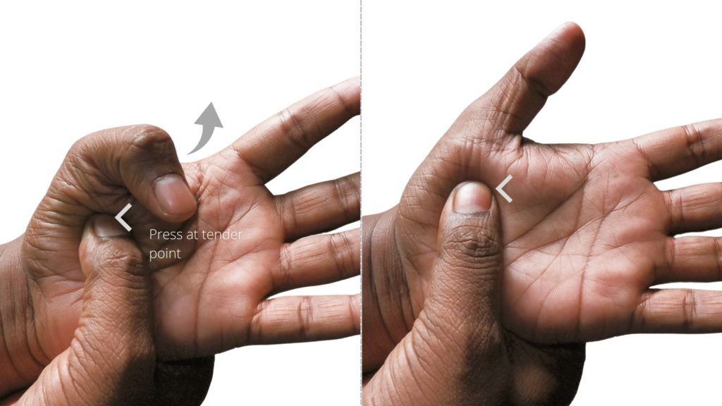 trigger finger in thumb treatment