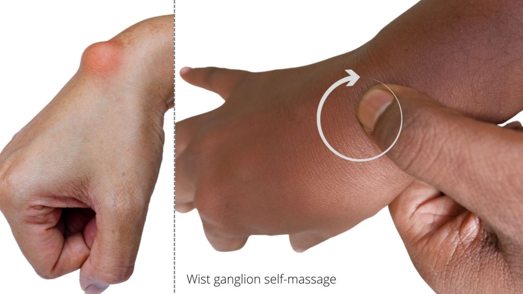 wrist ganglion self massage