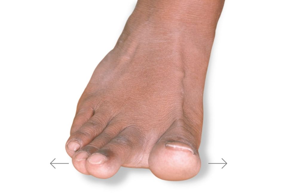 Toe spreading bunion corrector exercises