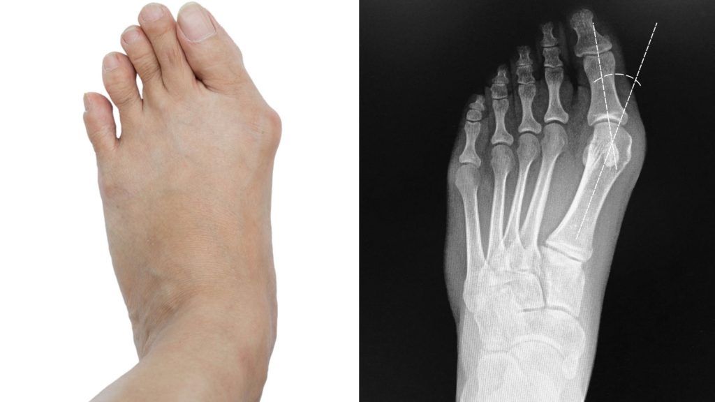 hallux valgus bunion anatomy