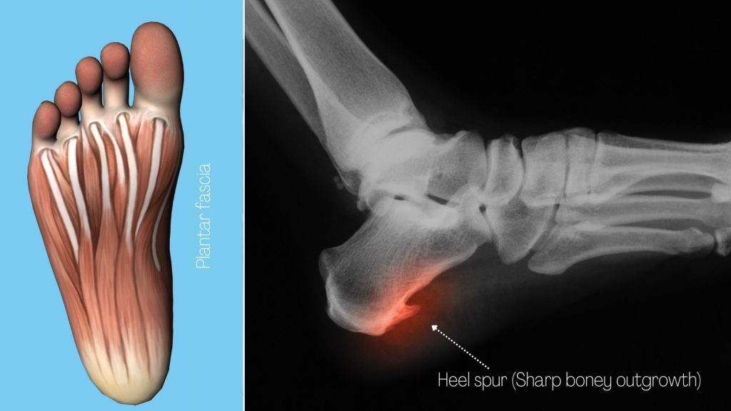 sharp heel pains due to plantar fasciitis heel spur