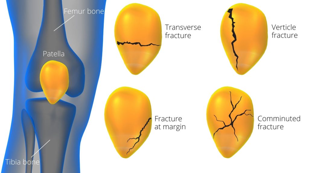 classification of patella fracture