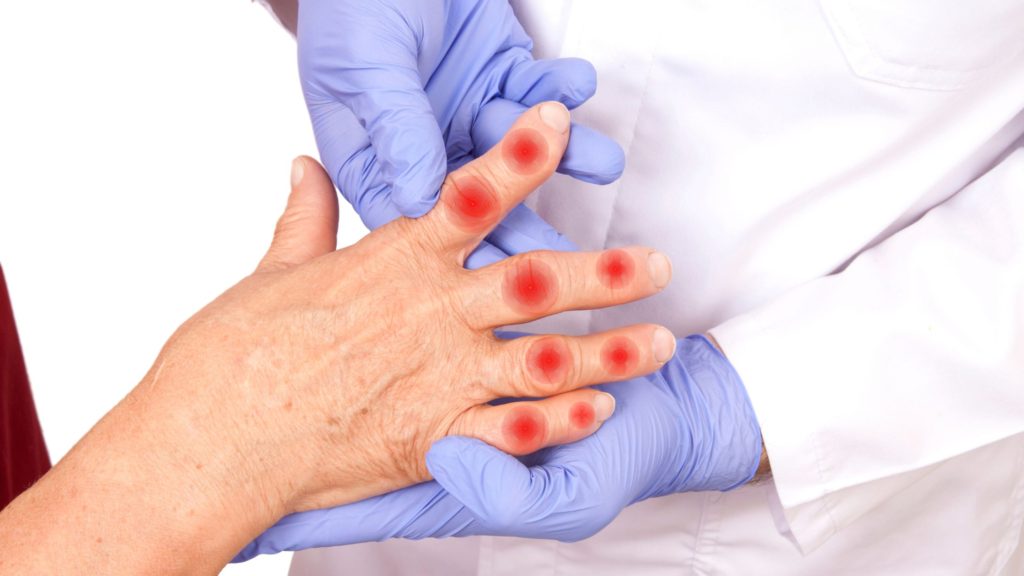 Newly Discovered Gut Bacteria May be  Culprit Behind Rheumatoid Arthritis  RA