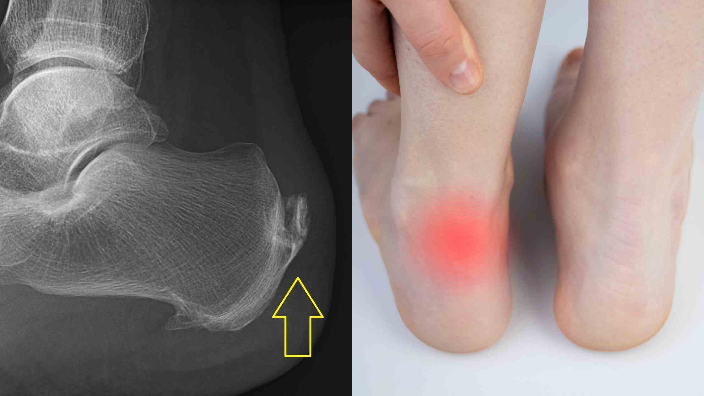 Calcification in Achilles Tendon Causes treatment physiotherapy