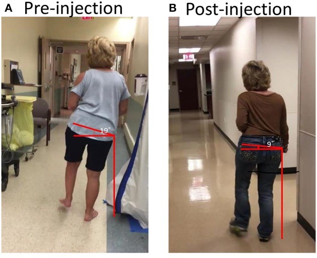 circumduction gait treatment using botulinum toxin injection