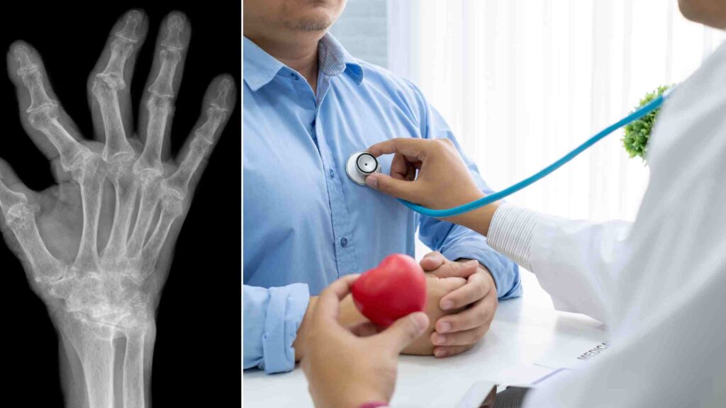 rheumatoid arthritis linked to cardiovascular heart disease