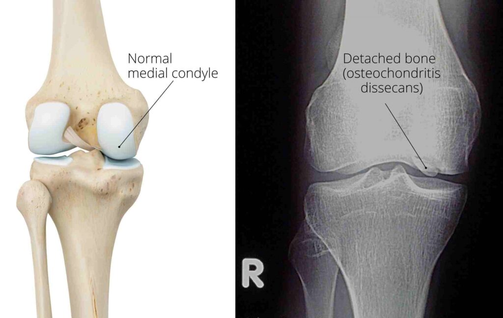 osteochondritis dissecans knee x-ray