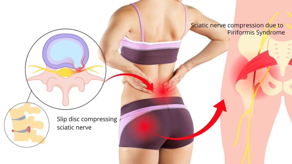 sciatic nerve compression