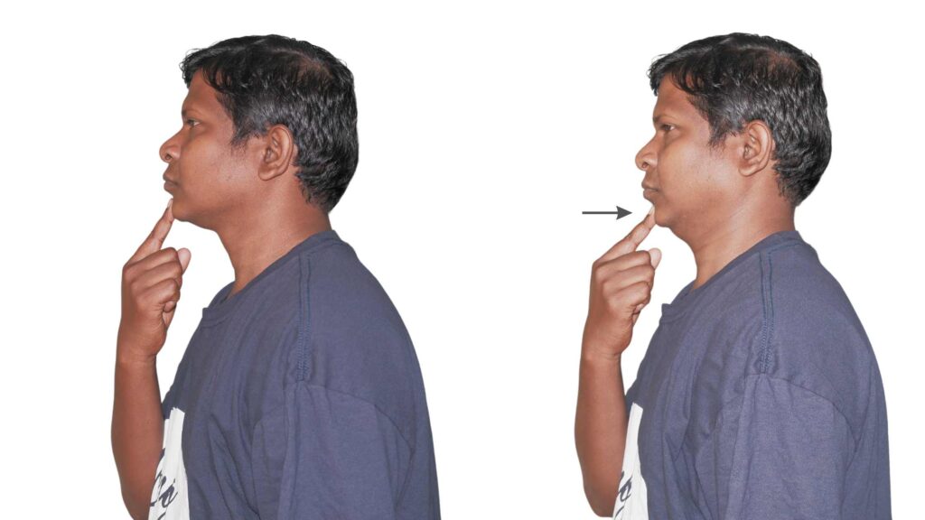 chin tuck exercise for cervicogenic headache