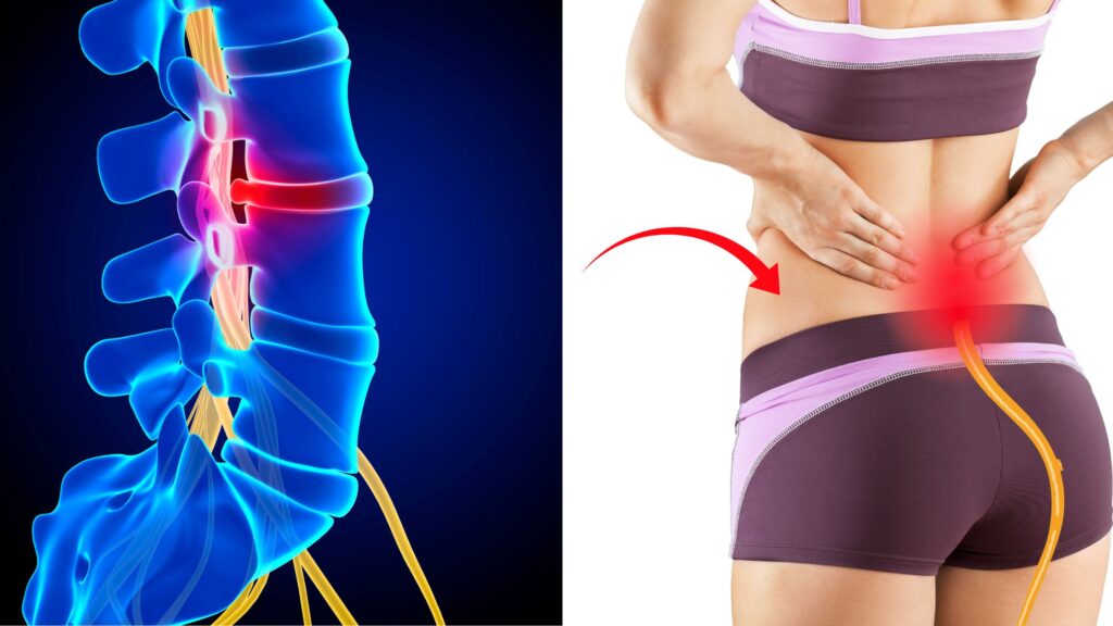 can disc bulge cause sciatica