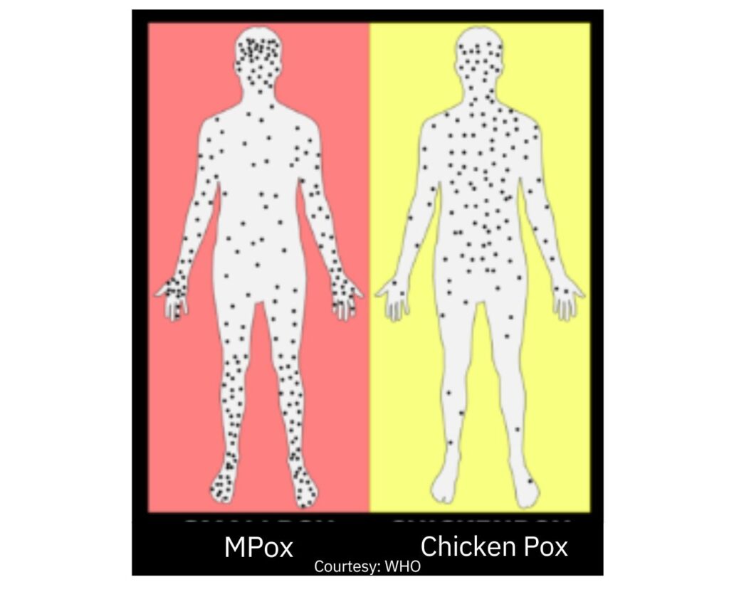 chicken pox vs mpox