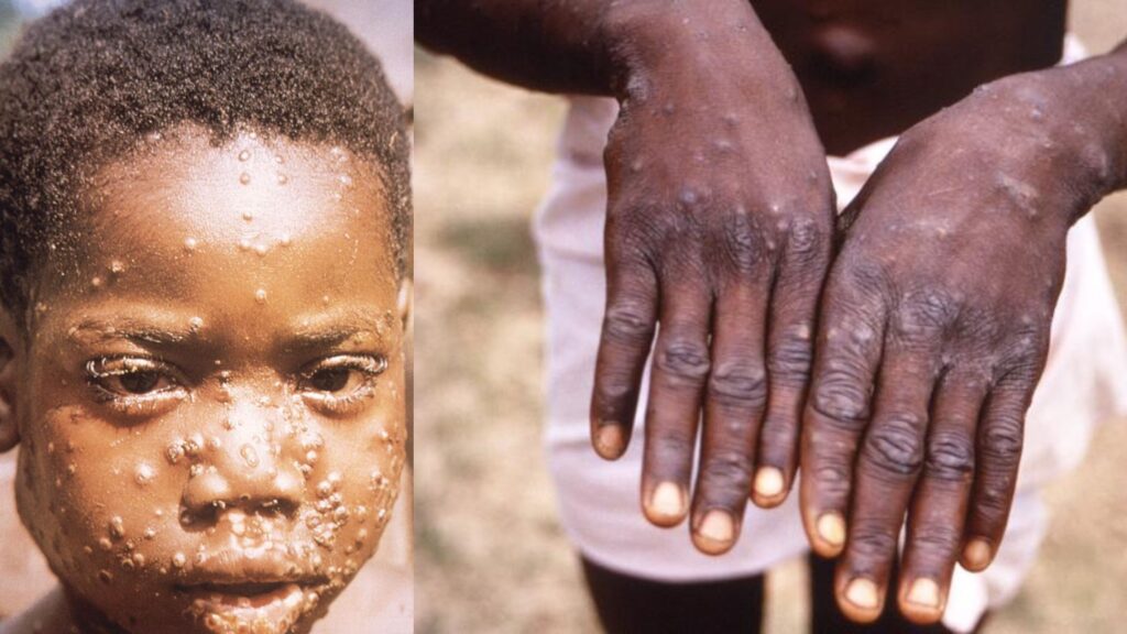 mpox or monkey pox rashes