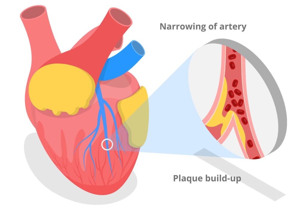 Clogged arteries could lead to a heart attack