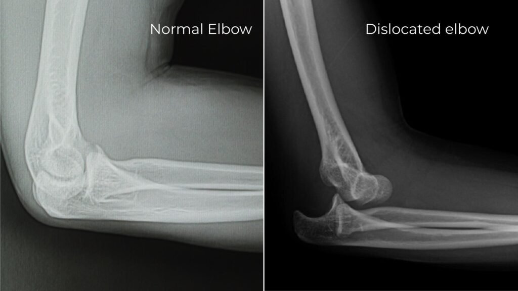 xray showing normal elbow compared to posterior dislocation of elbow