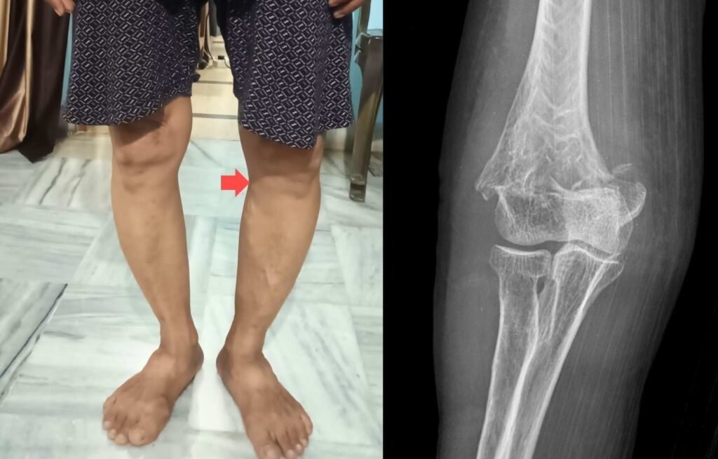 7 Risk factors of knee osteoarthritis. Take this free test to find your risk