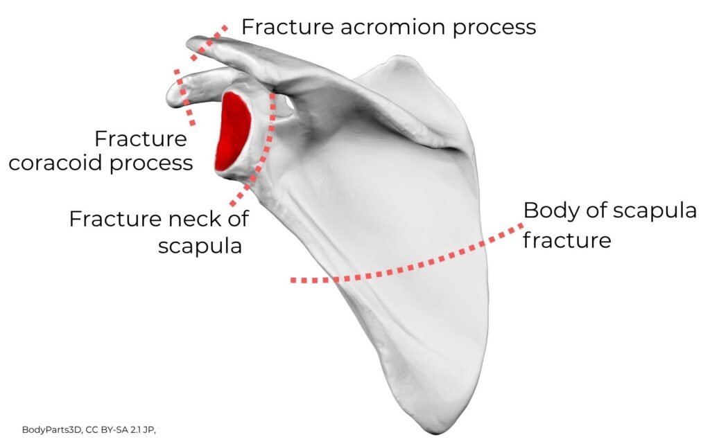 Fractures Scapula Four Different Sites 1024x644