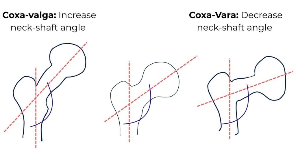 Hip Kinematics: Angle of Inclination, Declination & Joint Anatomy Explained Diagram comparing coxa valga (increased neck-shaft angle) and coxa vara (decreased neck-shaft angle) using femur illustrations with angled reference lines