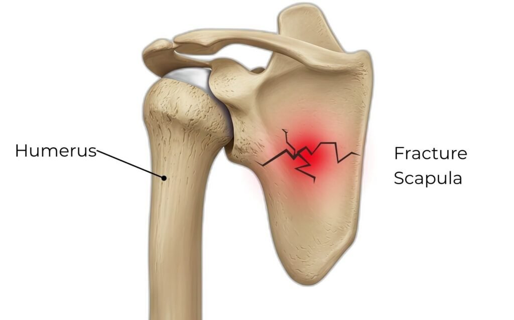 Fractures Scapula 20260624 134911 0000 11439898876020737444 1024x638