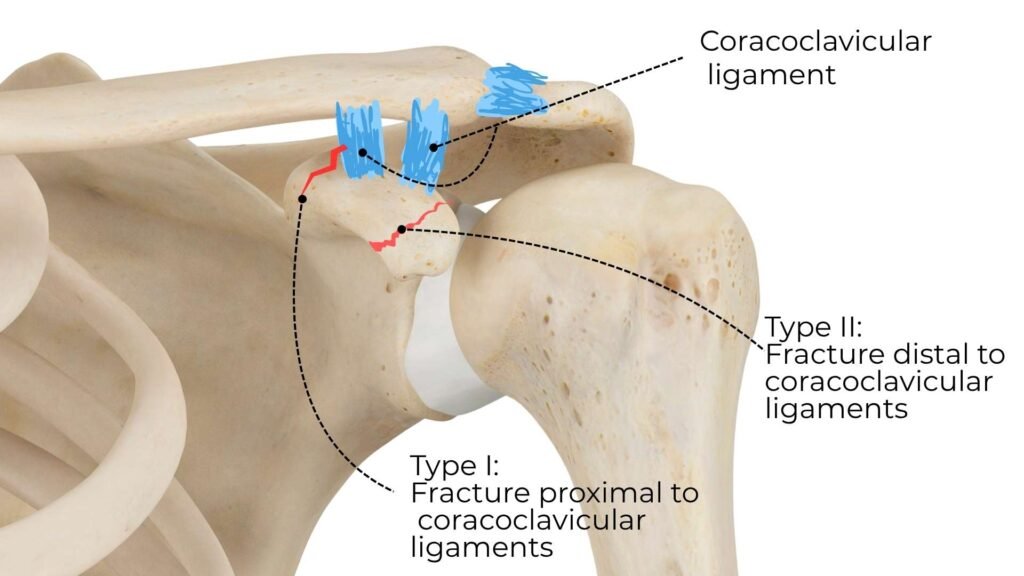 Ogawa Classification of coracoid process fractures: Type I fracture proximal to coracoclavicular ligaments; Type II fracture distal to coracoclavicular ligaments