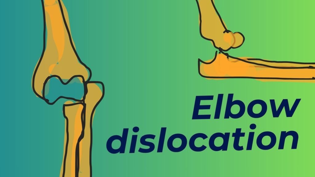 Elbow dislocation classification, diagnosis and treatment simplified for physiotherapy students