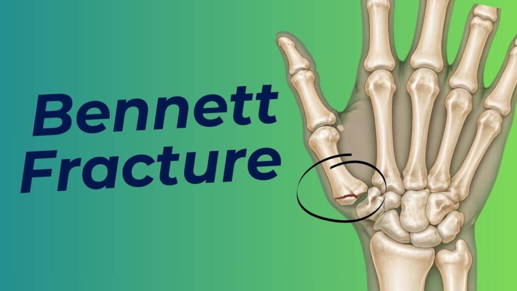 Bennett fracture dislocation of thumb metacarpal explained for physiotherapy students