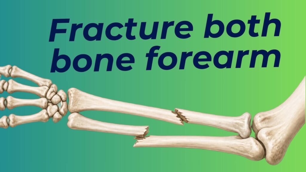 Fracture of both bones of forearm - ulna and radius fracture illustration for physiotherapy students